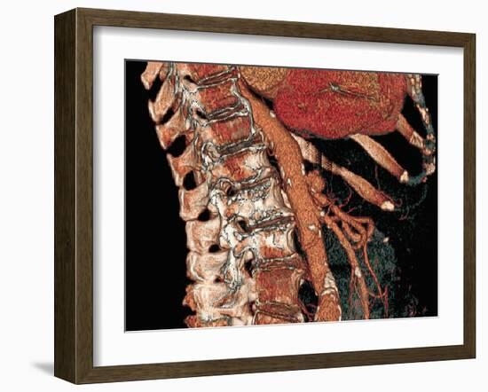 Abdominal Aorta And Spine, 3D CT Scan-Miriam Maslo-Framed Photographic Print