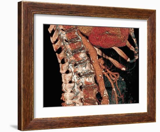 Abdominal Aorta And Spine, 3D CT Scan-Miriam Maslo-Framed Photographic Print