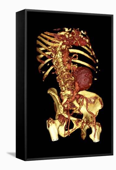 Abdominal Aortic Aneurysm, 3D CT Scan-Du Cane Medical-Framed Premier Image Canvas