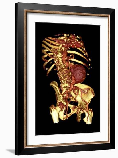 Abdominal Aortic Aneurysm, 3D CT Scan-Du Cane Medical-Framed Photographic Print