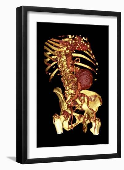 Abdominal Aortic Aneurysm, 3D CT Scan-Du Cane Medical-Framed Photographic Print