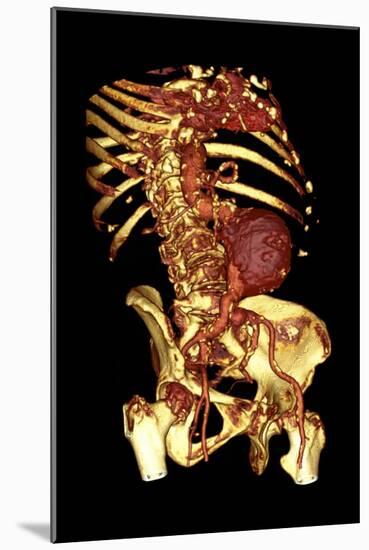 Abdominal Aortic Aneurysm, 3D CT Scan-Du Cane Medical-Mounted Photographic Print