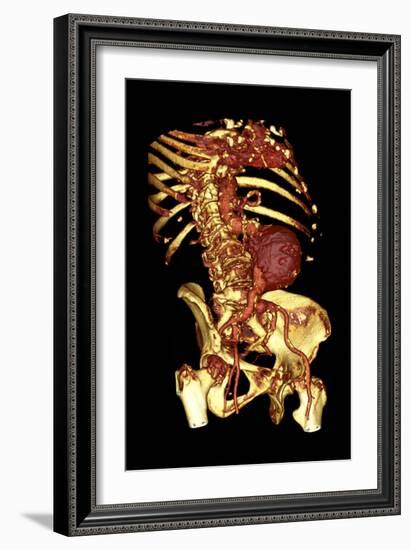 Abdominal Aortic Aneurysm, 3D CT Scan-Du Cane Medical-Framed Photographic Print