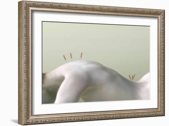 Acupuncture on Woman's Back, Artwork-Christian Darkin-Framed Photographic Print