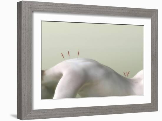 Acupuncture on Woman's Back, Artwork-Christian Darkin-Framed Photographic Print