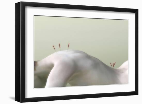 Acupuncture on Woman's Back, Artwork-Christian Darkin-Framed Photographic Print