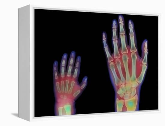 Adult And Child Hand X-rays-Science Photo Library-Framed Premier Image Canvas