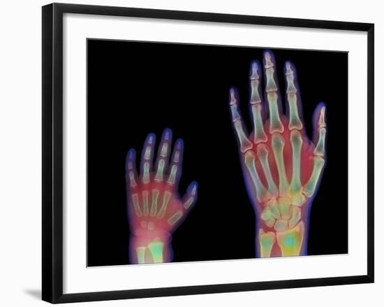 Adult And Child Hand X-rays-Science Photo Library-Framed Photographic Print