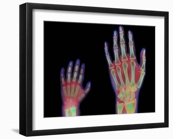 Adult And Child Hand X-rays-Science Photo Library-Framed Photographic Print