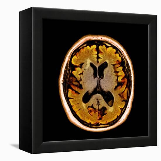 Alcoholic Dementia, MRI Scan-Du Cane Medical-Framed Premier Image Canvas