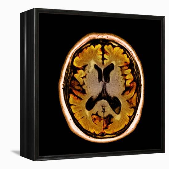 Alcoholic Dementia, MRI Scan-Du Cane Medical-Framed Premier Image Canvas