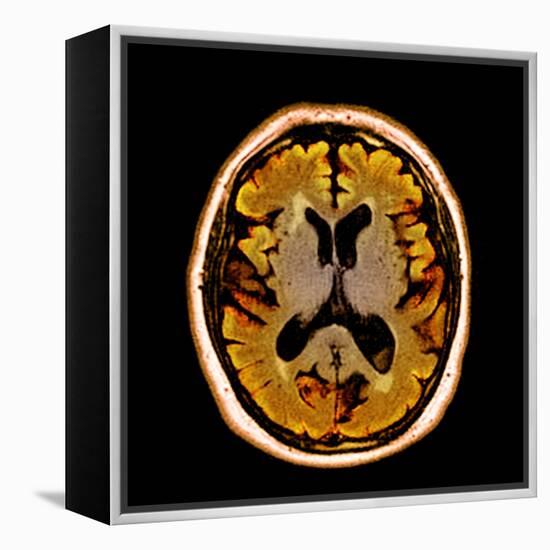 Alcoholic Dementia, MRI Scan-Du Cane Medical-Framed Premier Image Canvas