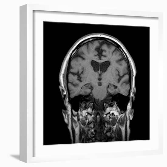 Alcoholic Dementia, MRI Scan-Du Cane Medical-Framed Photographic Print