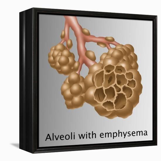 Alveoli with Emphysema-Gwen Shockey-Framed Premier Image Canvas