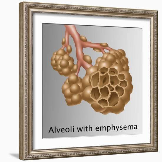 Alveoli with Emphysema-Gwen Shockey-Framed Giclee Print