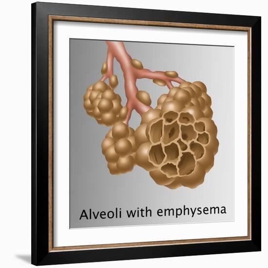 Alveoli with Emphysema-Gwen Shockey-Framed Giclee Print