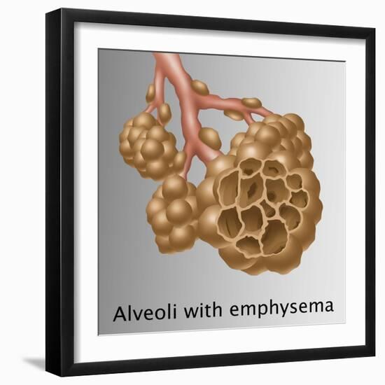 Alveoli with Emphysema-Gwen Shockey-Framed Giclee Print