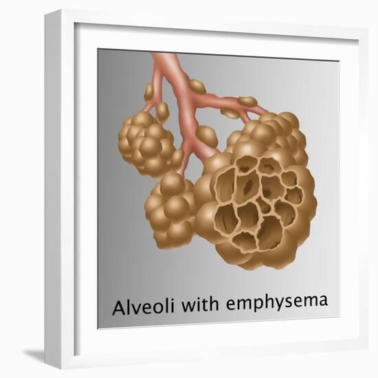 Alveoli with Emphysema-Gwen Shockey-Framed Giclee Print