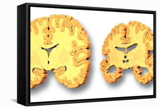 Alzheimer's Disease, Artwork-PASIEKA-Framed Premier Image Canvas