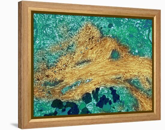 Alzheimer's Disease Brain Cell, TEM-Thomas Deerinck-Framed Premier Image Canvas