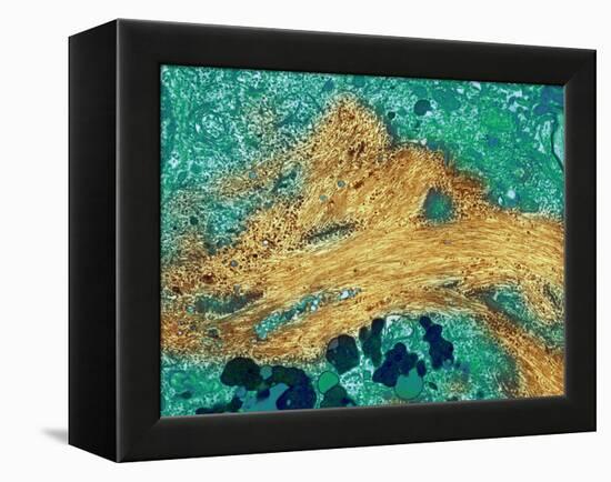 Alzheimer's Disease Brain Cell, TEM-Thomas Deerinck-Framed Premier Image Canvas