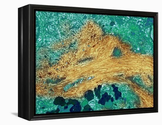 Alzheimer's Disease Brain Cell, TEM-Thomas Deerinck-Framed Premier Image Canvas