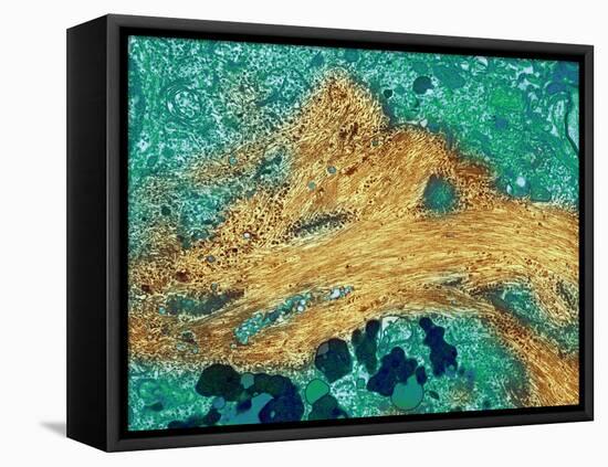 Alzheimer's Disease Brain Cell, TEM-Thomas Deerinck-Framed Premier Image Canvas