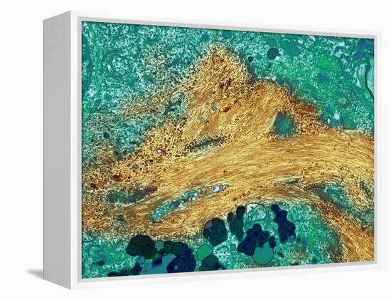 Alzheimer's Disease Brain Cell, TEM-Thomas Deerinck-Framed Premier Image Canvas