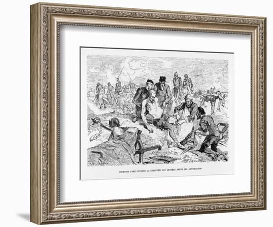 Ambroise Pare French Surgeon Invented the Procedure of Sewing up Arteries after Amputation-Figuier-Framed Art Print