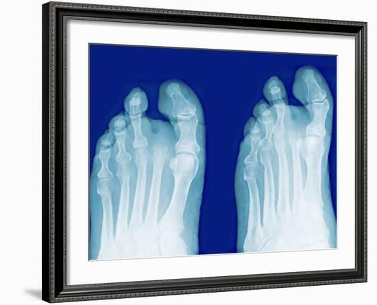 Amputated Toe, X-rays-Miriam Maslo-Framed Photographic Print