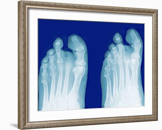 Amputated Toe, X-rays-Miriam Maslo-Framed Photographic Print