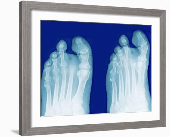 Amputated Toe, X-rays-Miriam Maslo-Framed Photographic Print