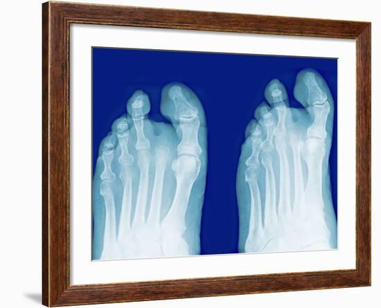 Amputated Toe, X-rays-Miriam Maslo-Framed Photographic Print