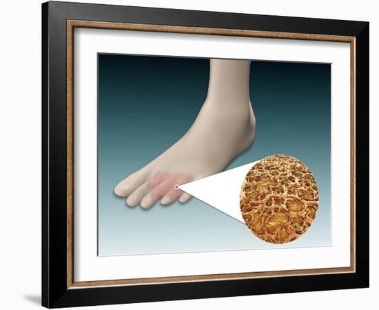 Anatomy of Foot Fungus with Microscopic Close-Up-null-Framed Art Print