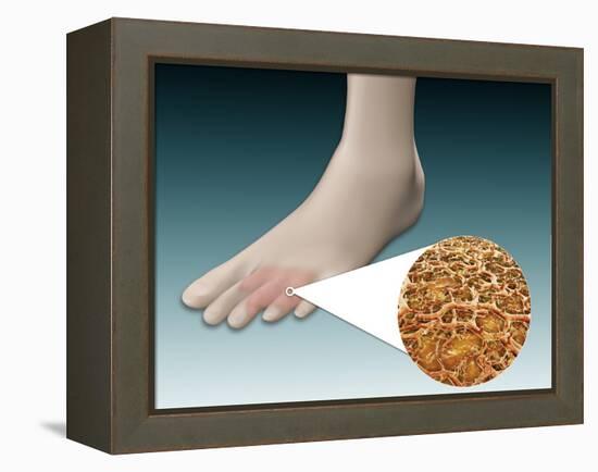 Anatomy of Foot Fungus with Microscopic Close-Up-null-Framed Stretched Canvas