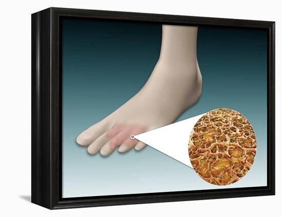 Anatomy of Foot Fungus with Microscopic Close-Up-null-Framed Stretched Canvas