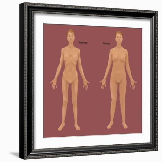 Anorexia Nervosa-Gwen Shockey-Framed Giclee Print