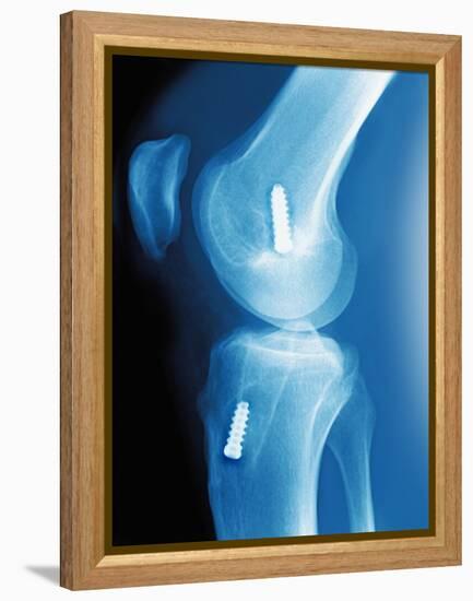 Anterior Cruciate Ligament Repair, X-ray-Miriam Maslo-Framed Premier Image Canvas