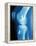 Anterior Cruciate Ligament Repair, X-ray-Miriam Maslo-Framed Premier Image Canvas