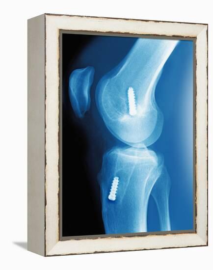 Anterior Cruciate Ligament Repair, X-ray-Miriam Maslo-Framed Premier Image Canvas