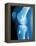 Anterior Cruciate Ligament Repair, X-ray-Miriam Maslo-Framed Premier Image Canvas