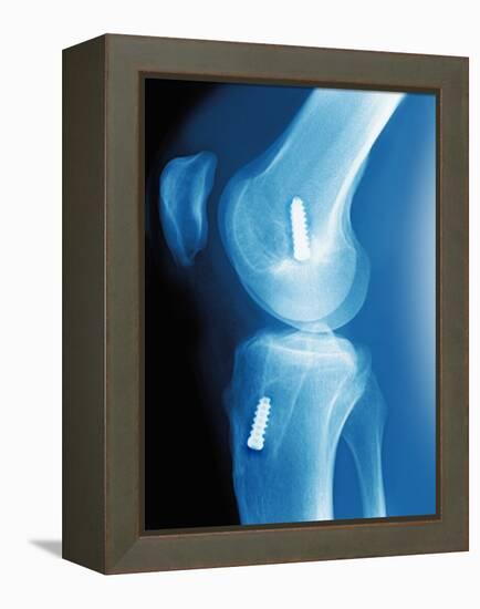 Anterior Cruciate Ligament Repair, X-ray-Miriam Maslo-Framed Premier Image Canvas