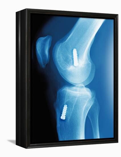 Anterior Cruciate Ligament Repair, X-ray-Miriam Maslo-Framed Premier Image Canvas