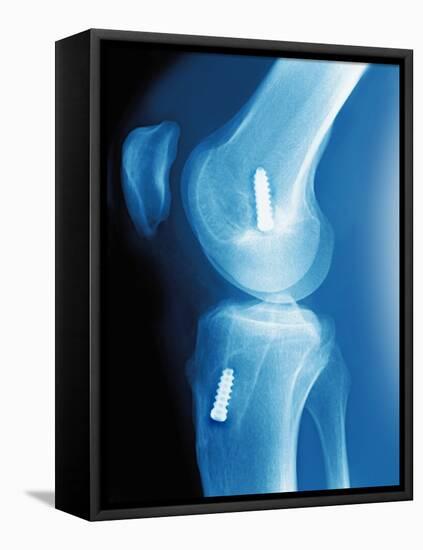 Anterior Cruciate Ligament Repair, X-ray-Miriam Maslo-Framed Premier Image Canvas