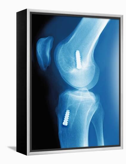 Anterior Cruciate Ligament Repair, X-ray-Miriam Maslo-Framed Premier Image Canvas