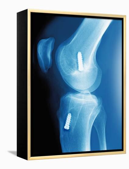 Anterior Cruciate Ligament Repair, X-ray-Miriam Maslo-Framed Premier Image Canvas