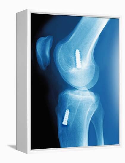 Anterior Cruciate Ligament Repair, X-ray-Miriam Maslo-Framed Premier Image Canvas