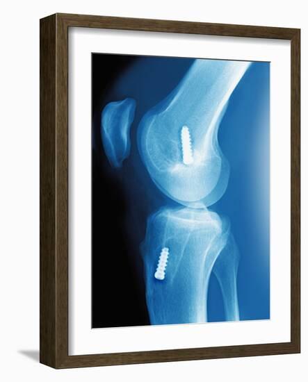 Anterior Cruciate Ligament Repair, X-ray-Miriam Maslo-Framed Photographic Print