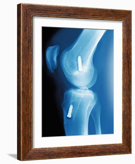 Anterior Cruciate Ligament Repair, X-ray-Miriam Maslo-Framed Photographic Print