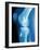 Anterior Cruciate Ligament Repair, X-ray-Miriam Maslo-Framed Photographic Print